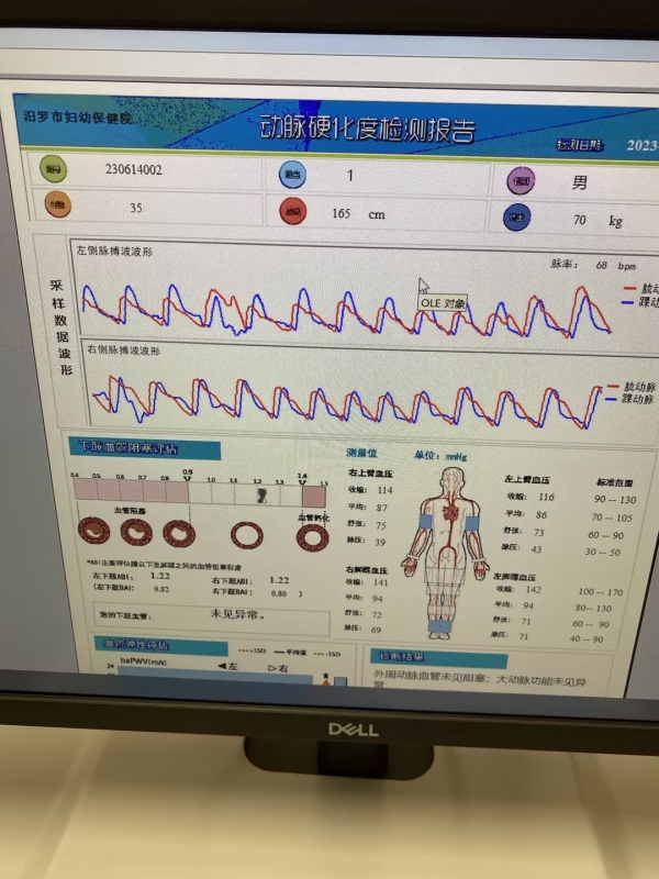 动脉硬化检测仪：心血管疾病预防和治疗的重要工具